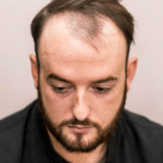 Man with hair loss at a consultation for a hair system in manchester hair salon