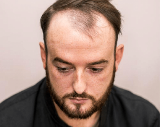 Hair loss on top of head before hair replacement Manchester