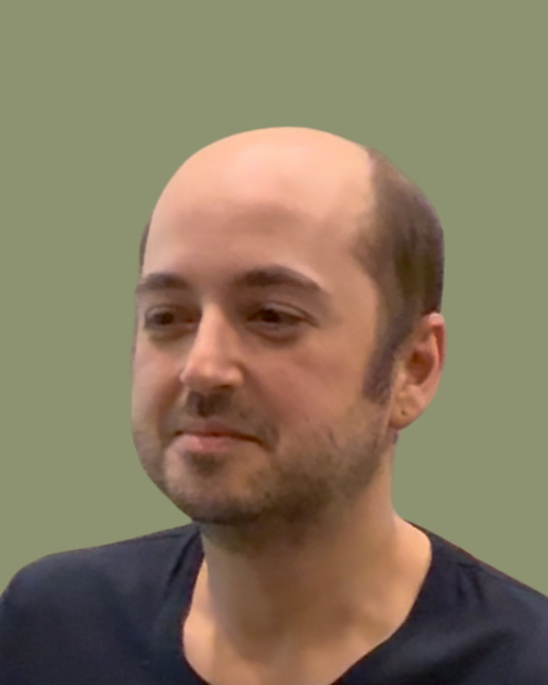 Man with thin hair and hair loss before his hair system treatment