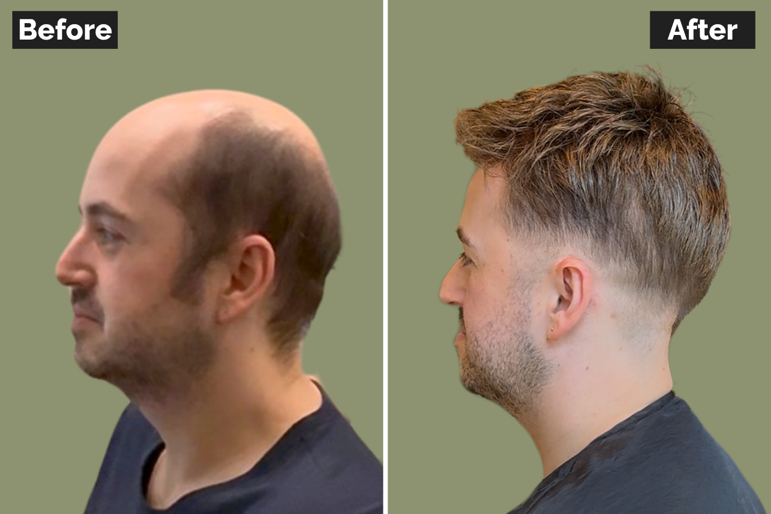 Before and after of a mans hair system fitted by David Rozman